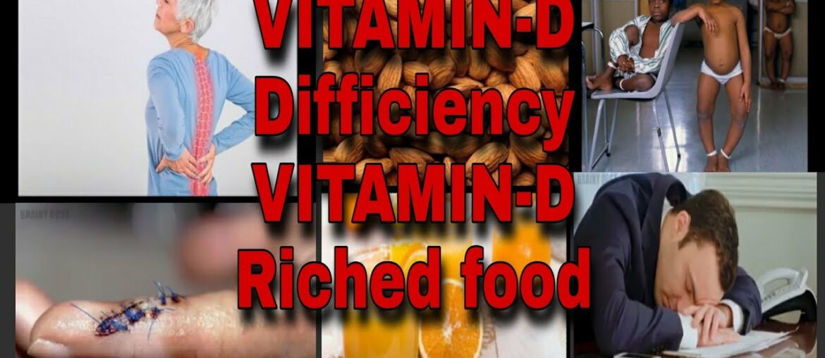 VITAMIN-D dificiency problem /Foods Rich in VITAMIN -D