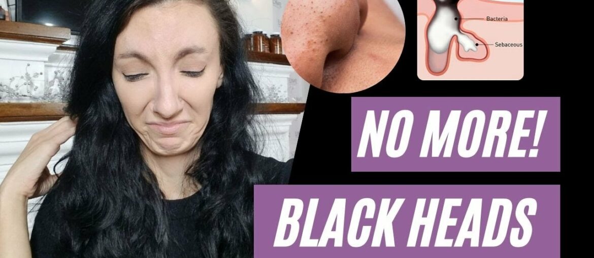 The BEST Advice You Will Ever Get | How To Get Rid Of Blackheads FOR GOOD