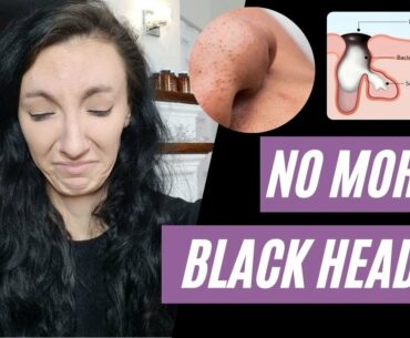 The BEST Advice You Will Ever Get | How To Get Rid Of Blackheads FOR GOOD