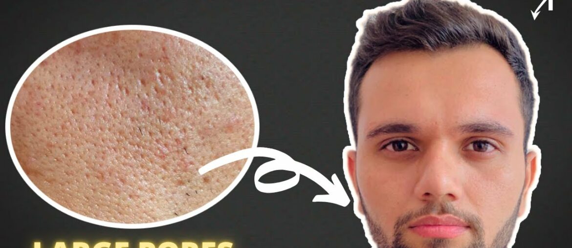 HOW TO GET RID OF LARGE OPEN PORES | SHRINK LARGE PORES | HINDI | MakePresentable