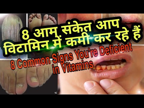 vitamin deficiency syndrome in Hindi