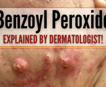 How To Use Benzoyl Peroxide Gel For Acne (Benzac) - Dermatologist explains