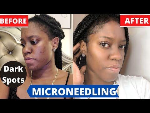 How To Get Rid Of Acne Scars|Hyperpigmentation| Microneedling With Glutathione and Vitamin C.