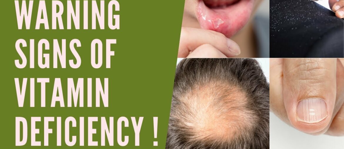 VITAMIN DEFICIENCY SYMPTOMS | WARNING SIGNS TO CHECK IF YOUR BODY IS DEFICIENT IN VITAL NUTRIENTS