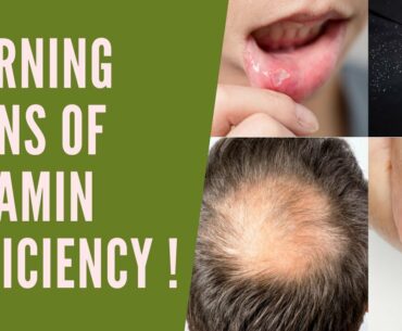 VITAMIN DEFICIENCY SYMPTOMS | WARNING SIGNS TO CHECK IF YOUR BODY IS DEFICIENT IN VITAL NUTRIENTS