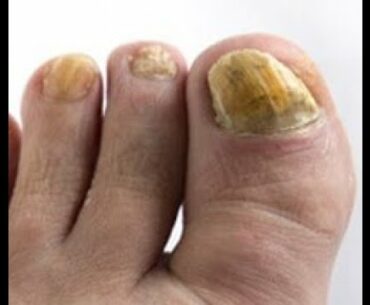 How to Solve Fungal Nail Infections