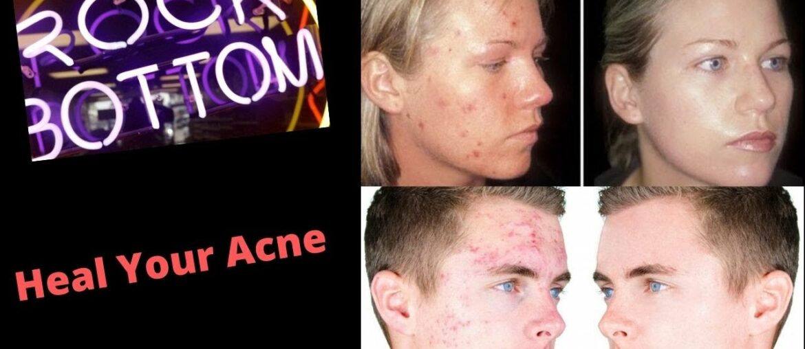 Cure Acne with Nutritional Supplements and Vitamins