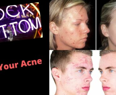 Cure Acne with Nutritional Supplements and Vitamins