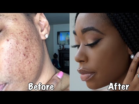 HOW I PREVENT HYPERPIGMENTATION WHILE WEARING MAKEUP|ChimereNicole