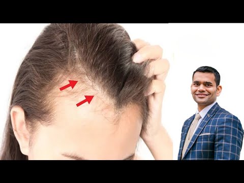 Hair fall? This Vitamin can Really Help You | Dr. Vivek Joshi