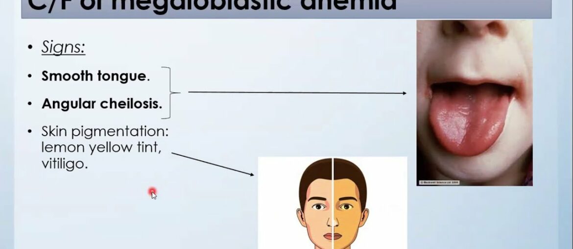 Megaloblastic Anaemia | Vitamin B12,Folate deficiency | Pernicious Anemia