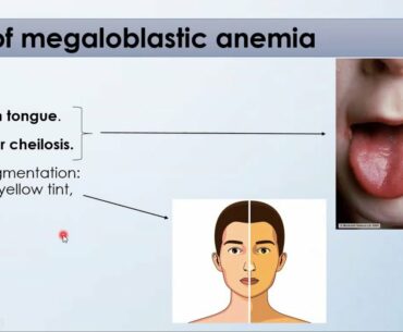 Megaloblastic Anaemia | Vitamin B12,Folate deficiency | Pernicious Anemia