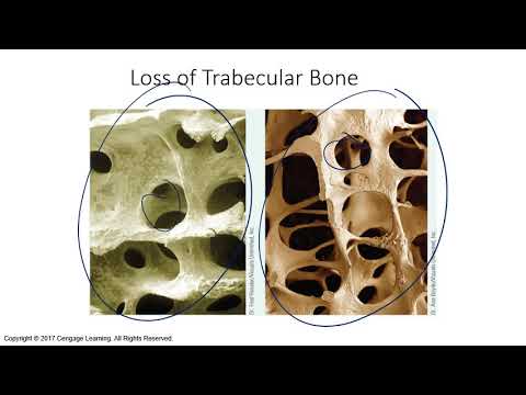 Nutrition   Chap 08e   Osteoporosis 20201018