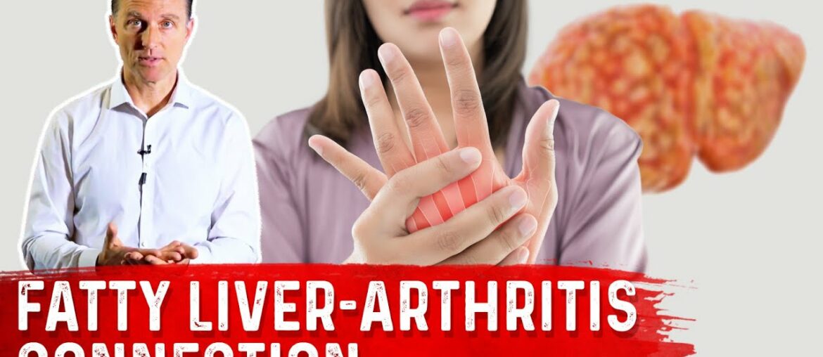 Why Does a Fatty Liver Triggers Arthritis?