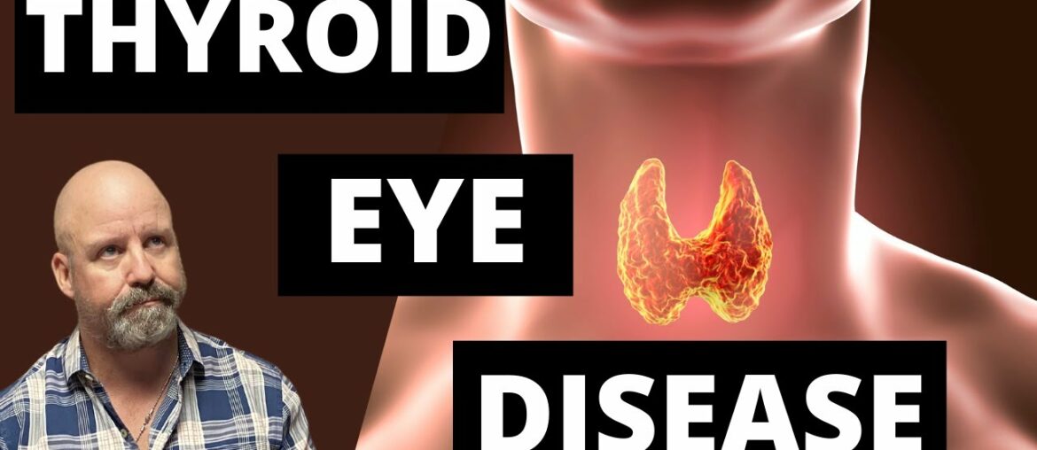 Thyroid Eye Disease. Symptoms, Treatments, and what you need to know.