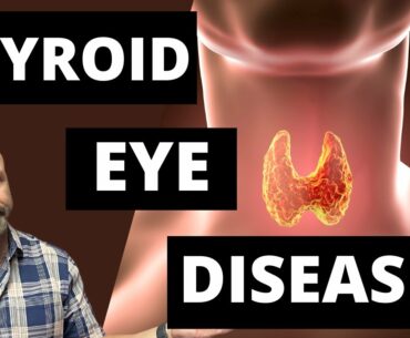 Thyroid Eye Disease. Symptoms, Treatments, and what you need to know.