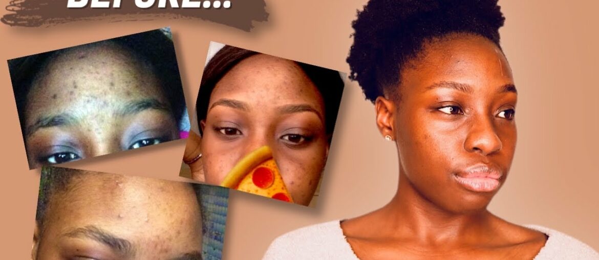 HOW I GOT RID OF *SPOTS AND SCARS* ON MY FACE || *before&after pictures*