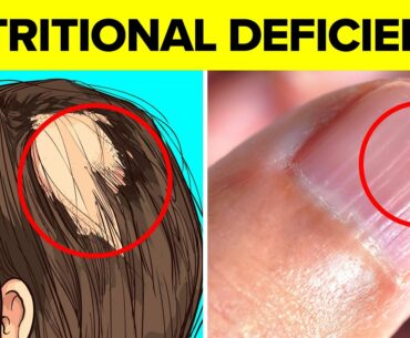14 Signs That Indicate You Have A Nutritional Deficiency