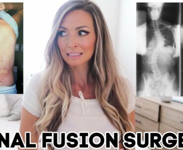 My SPINAL FUSION STORY | SCOLIOSIS SURGERY | 20 Years Post-Op