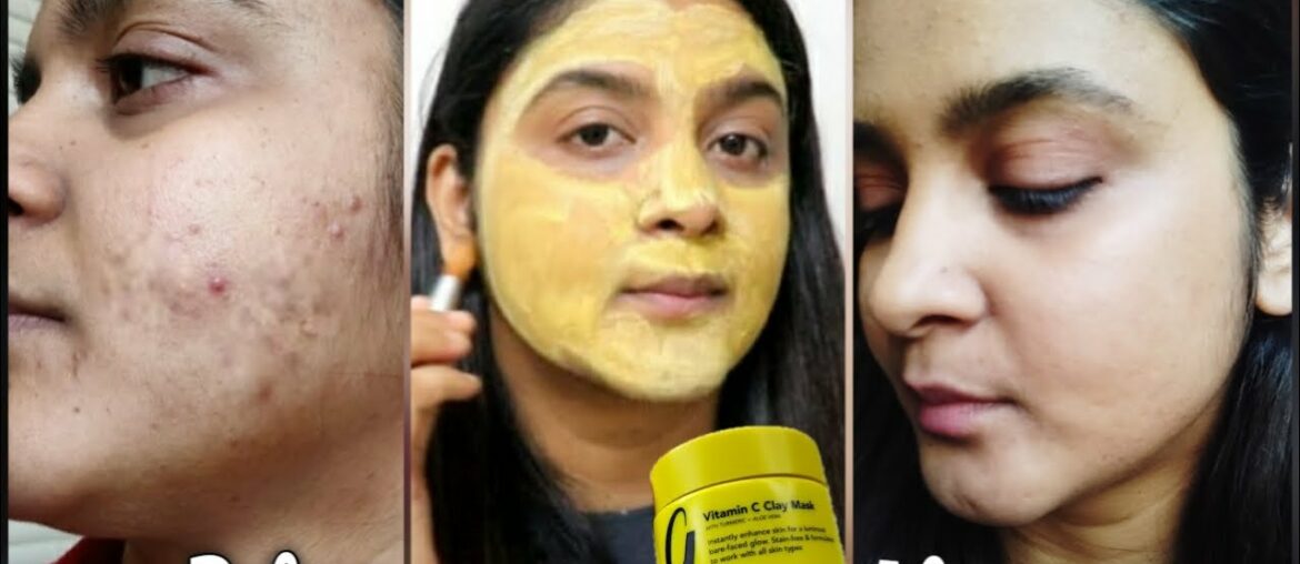 Best Face Mask For Acne Scars ,Dark Spots & Hyperpigmentation |Gleamin Vitamin C Clay Mask Review