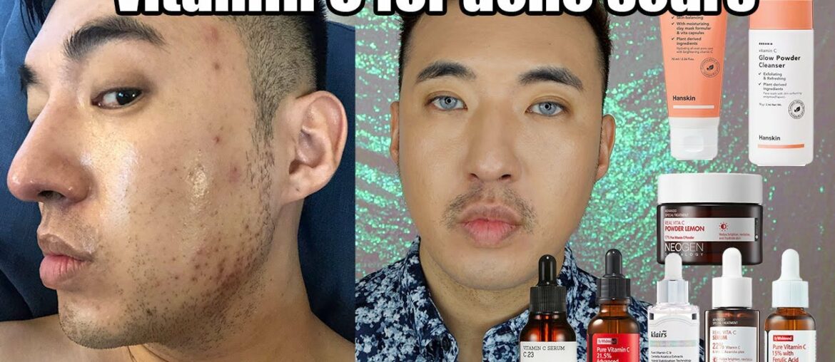 Vitamin C for acne scars / hyperpigmentation | K-Beauty | NEOGEN, Klairs, Wishtrend, Hanskin