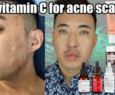 Vitamin C for acne scars / hyperpigmentation | K-Beauty | NEOGEN, Klairs, Wishtrend, Hanskin