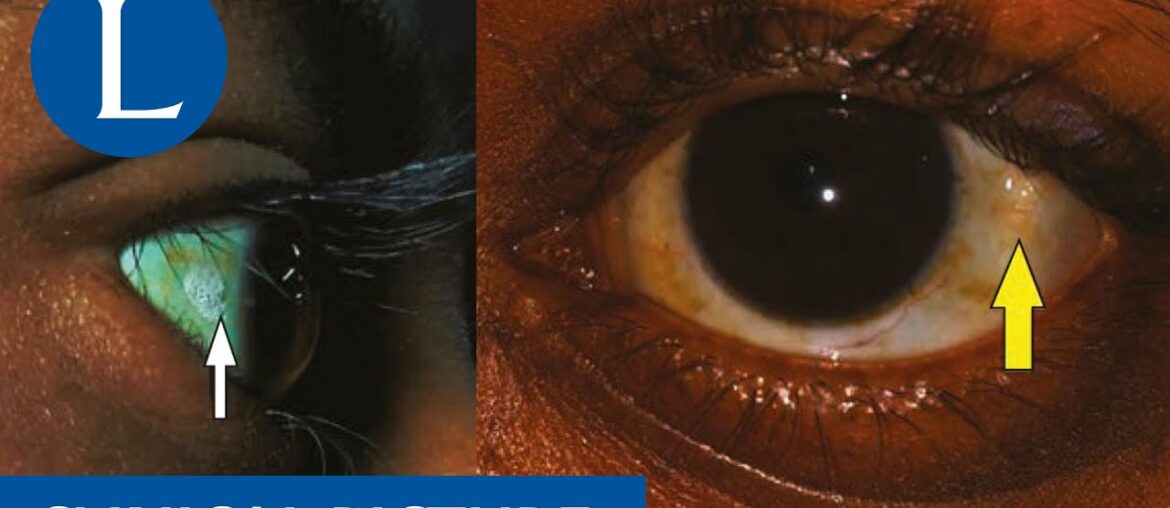 Clinical Picture | Bitot's spots, dry eyes, and night blindness indicate vitamin A deficiency