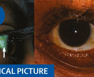 Clinical Picture | Bitot's spots, dry eyes, and night blindness indicate vitamin A deficiency