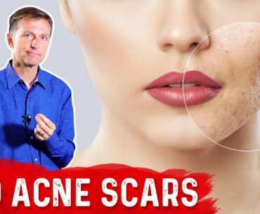 Best Way to Rid Acne Scars