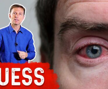 What Causes Bloodshot Eyes?