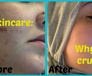 Why proper skin care matters | Health and Fitness | How I cleared up my skin | Affordable products