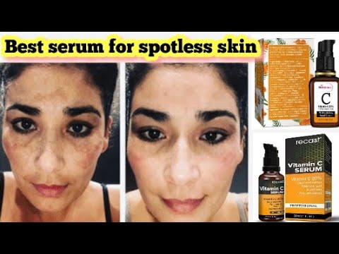 Best vitamin c serum for face | Pigmentation | melasma | Acne scars | Fair skin | Brijwasi Girl
