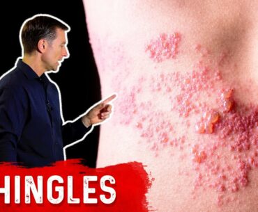 Shingles: Natural Relief