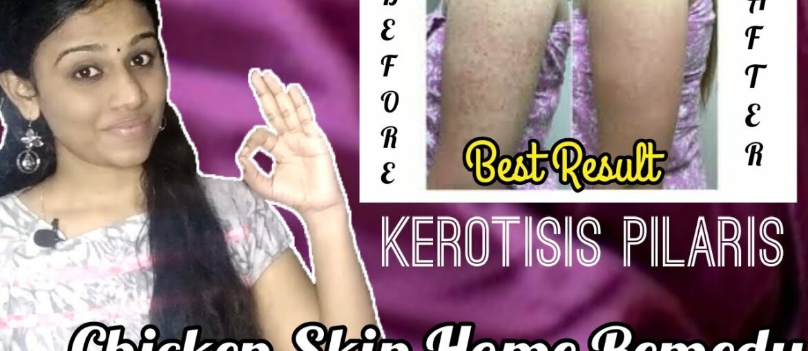 Kerotisis Pilaris | Chicken Skin | Home Remedy | Vitamin A deficiency | Skin Care |Tamil Beauty Tips