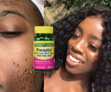 Spring Valley Prenatal Vitamins | My secret to Clear Skin?!!! Healing my Acne Fast