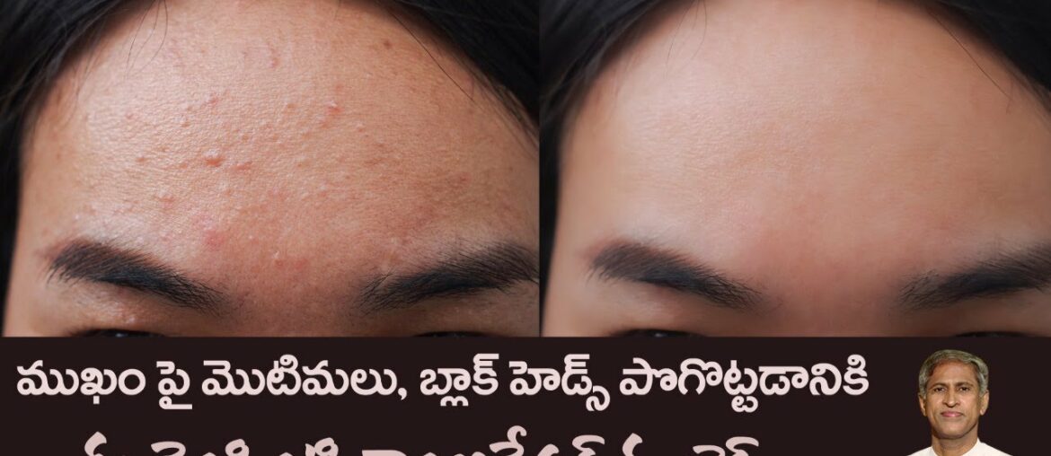 Remove Pimples and Dead Cells | Vitamin C Face Pack | Bright and Fair Skin |Dr.Manthena's Beauty Tip